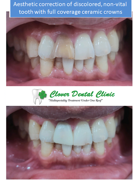 https://cloverdentalclinic.co/wp-content/uploads/2024/03/Aesthetic-correction-of-discolored-non-vital-tooth-with-full-coverage-ceramic-crowns.png