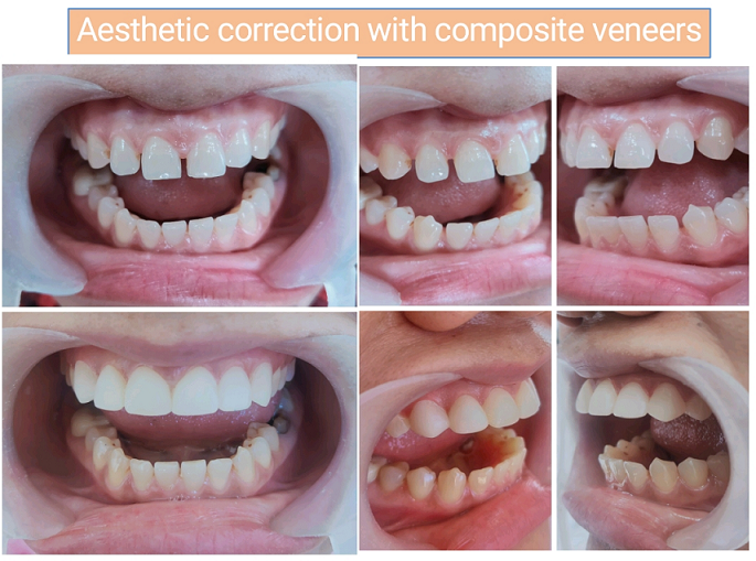 Aesthetic correction with composite veneers