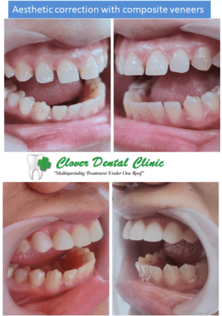 https://cloverdentalclinic.co/wp-content/uploads/2024/03/Aesthetic-correction-with-composite-veneers-2-320x455.png