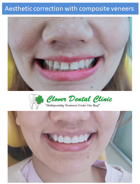 https://cloverdentalclinic.co/wp-content/uploads/2024/03/Aesthetic-correction-with-composite-veneers.png