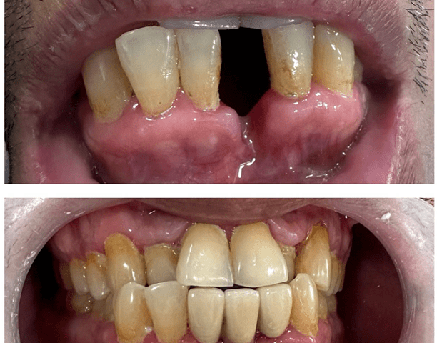 https://cloverdentalclinic.co/wp-content/uploads/2024/03/Correction-of-anatomical-defect-and-missing-612x480.png