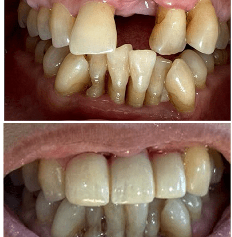 https://cloverdentalclinic.co/wp-content/uploads/2024/03/Correction-of-crooked-tooth-and-replacement-471x480.png