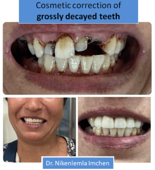 Cosmetic correction of grossly decayed teeth