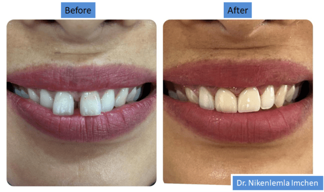 https://cloverdentalclinic.co/wp-content/uploads/2024/03/Cosmetic-correction-of-protruted-front-teeth-with-midline-diastema-tooth-gap-2-640x379.png