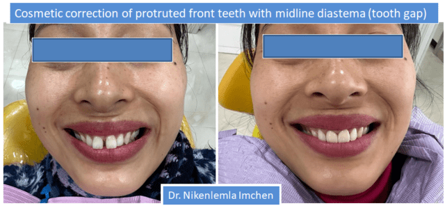 https://cloverdentalclinic.co/wp-content/uploads/2024/03/Cosmetic-correction-of-protruted-front-teeth-with-midline-diastema-tooth-gap-640x299.png