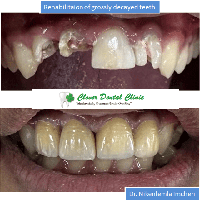 https://cloverdentalclinic.co/wp-content/uploads/2024/03/Rehabilitaion-of-grossly-decayed-teeth-640x642.png