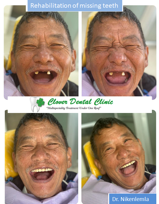 https://cloverdentalclinic.co/wp-content/uploads/2024/03/Rehabilitation-of-missing-teeth.png