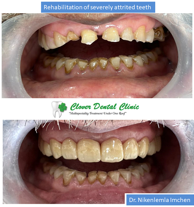 https://cloverdentalclinic.co/wp-content/uploads/2024/03/Rehabilitation-of-severely-attrited-teeth-2.png