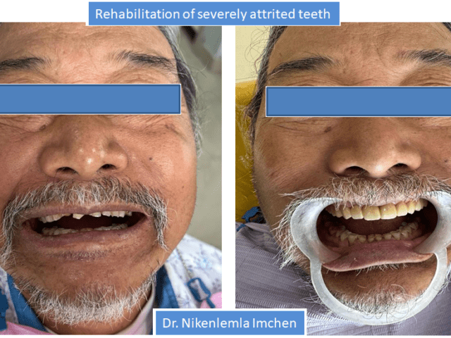 https://cloverdentalclinic.co/wp-content/uploads/2024/03/Rehabilitation-of-severely-attrited-teeth-640x480.png