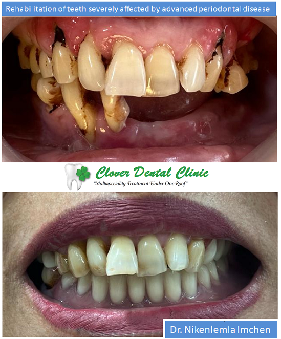 https://cloverdentalclinic.co/wp-content/uploads/2024/03/Rehabilitation-of-teeth-severely-affected-by-advanced-periodontal-disease.png