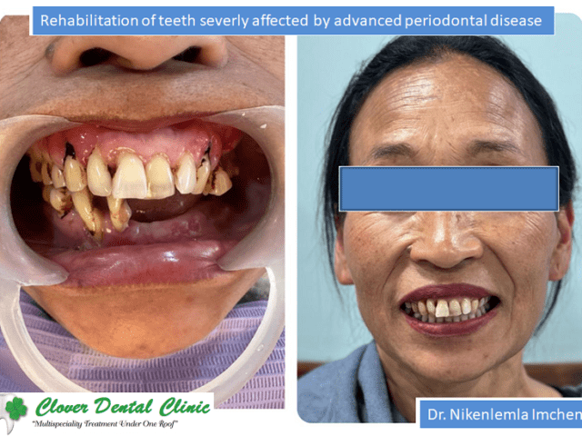 https://cloverdentalclinic.co/wp-content/uploads/2024/03/Rehabilitation-of-teeth-severly-affected-by-advanced-periodontal-disease-640x480.png