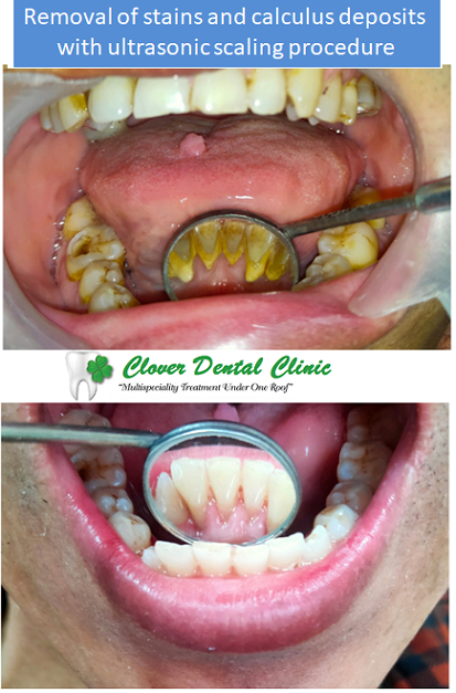 https://cloverdentalclinic.co/wp-content/uploads/2024/03/Removal-of-stains-and-calculus-deposits-with-ultrasonic-scaling-procedure-2.png