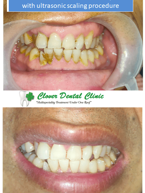 https://cloverdentalclinic.co/wp-content/uploads/2024/03/Removal-of-stains-and-calculus-deposits-with-ultrasonic-scaling-procedure-481x640.png