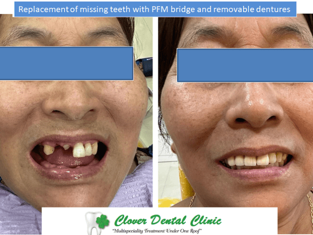 https://cloverdentalclinic.co/wp-content/uploads/2024/03/Replacement-of-missing-teeth-with-PFM-bridge-and-removable-dentures-640x480.png