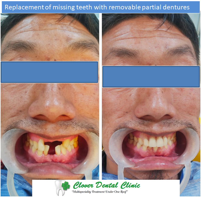 https://cloverdentalclinic.co/wp-content/uploads/2024/03/Replacement-of-missing-teeth-with-removable-partial-dentures-part-2.png