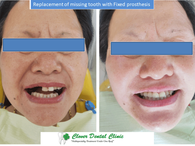 https://cloverdentalclinic.co/wp-content/uploads/2024/03/Replacement-of-missing-tooth-with-Fixed-prosthesis-640x480.png