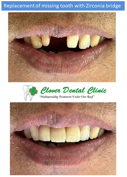 https://cloverdentalclinic.co/wp-content/uploads/2024/03/Replacement-of-missing-tooth-with-Zirconia-bridge.png