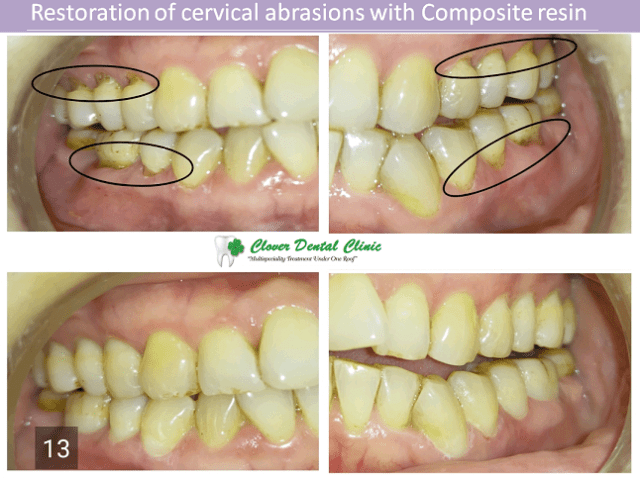 Restoration of cervical abrasions with Composite resin