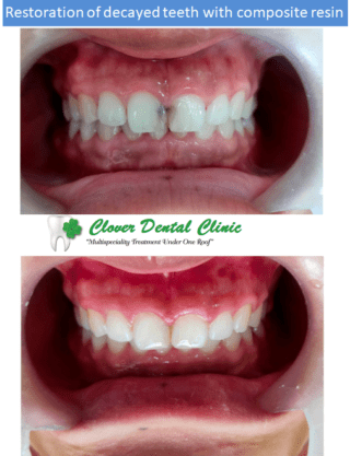 https://cloverdentalclinic.co/wp-content/uploads/2024/03/Restoration-of-decayed-teeth-with-composite-resin-320x417.png