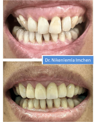 https://cloverdentalclinic.co/wp-content/uploads/2024/03/Smile-designing-Cosmetic-correction-of-gummy-smile-with-mal-aligned-teeth-3-320x414.png