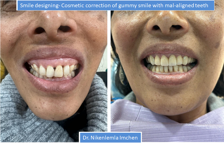 https://cloverdentalclinic.co/wp-content/uploads/2024/03/Smile-designing-Cosmetic-correction-of-gummy-smile-with-mal-aligned-teeth.png