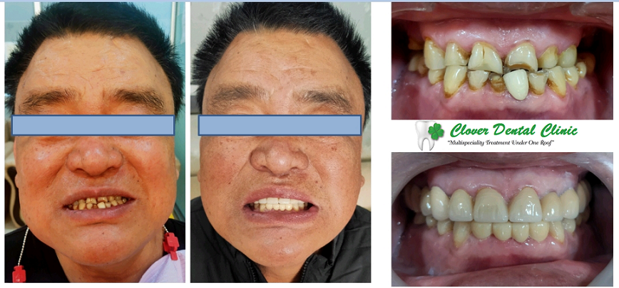 Complete smile transformation with full mouth rehabilitation