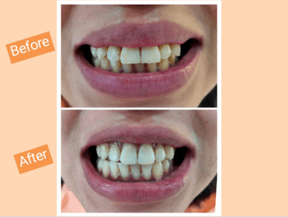 https://cloverdentalclinic.co/wp-content/uploads/2024/03/dental-treatment-before-and-after-photos-1-320x242.png