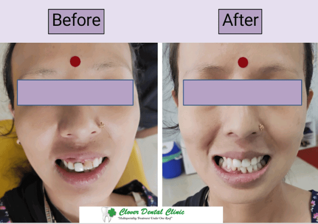 dental treatment before and after photos