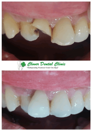 dental treatment images before and after